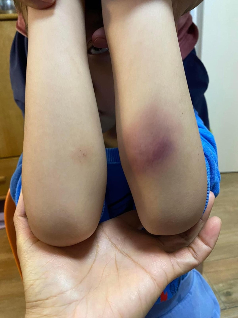 陈妈妈指，她的8岁儿子在3月底有日放学后手肘出现大片瘀伤。