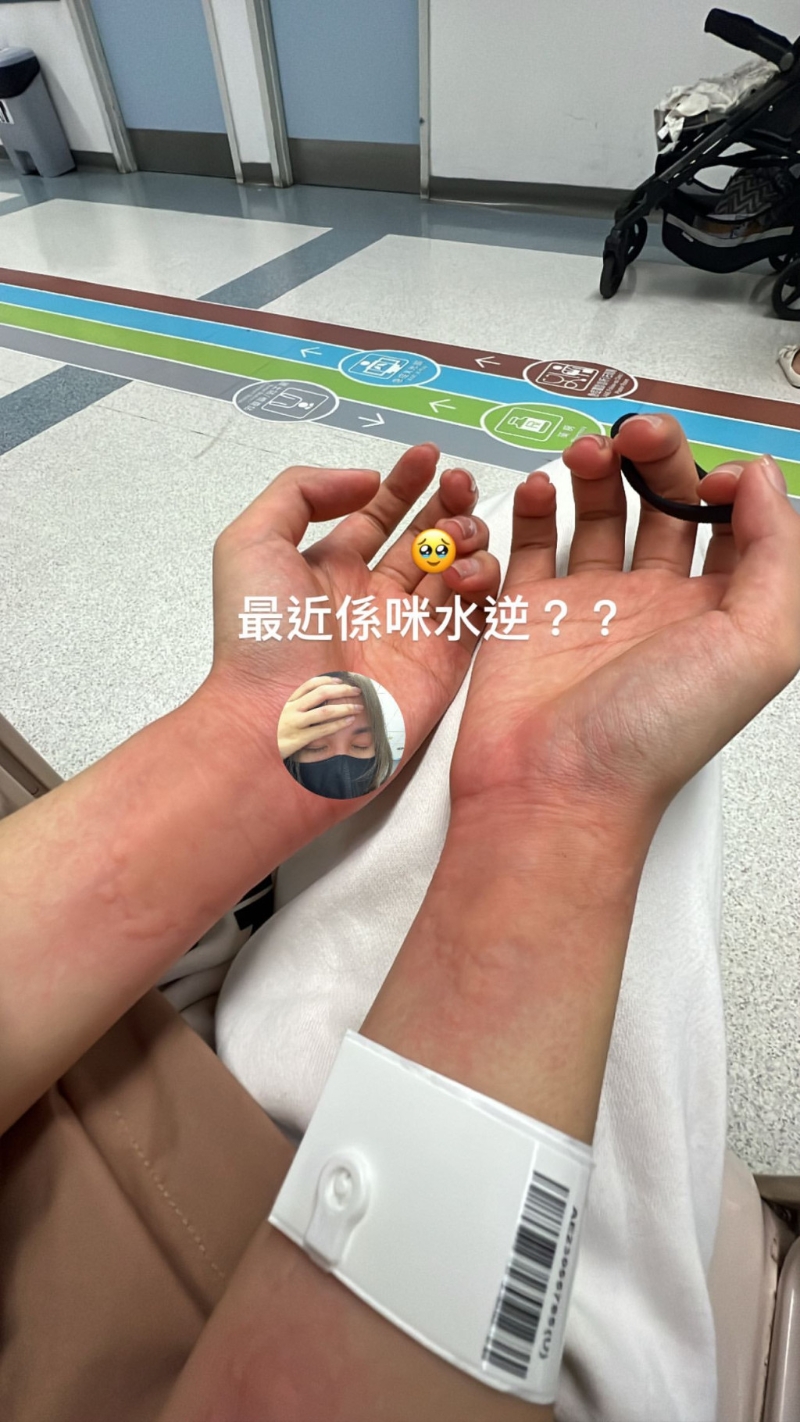 庄子璇昨日凌晨晒出照片，见她手上戴上病人手带，两双手腕及前臂位置又红又肿。