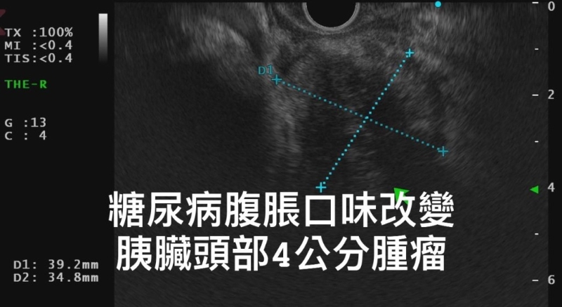 男子的胰脏肿瘤长达4cm（图片获胃肠肝胆科医生林相宏授权转载）