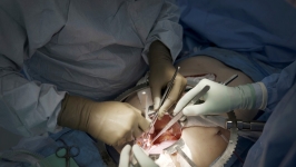 猪肾移植人体 | 迈向新里程碑，美国展开全球首项正式临床试验