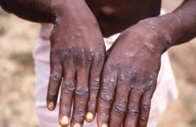 Monkeypox to be included as statutorily notifiable infectious disease