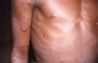 西班牙再有猴痘患者不治，与首宗死亡相隔仅一日
