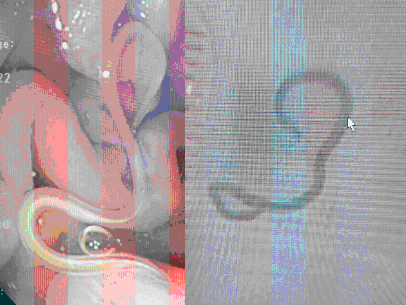 吳文傑醫生表示，病者因進食魚生後感染寄生蟲。（相片獲吳文傑醫生授權轉載） 