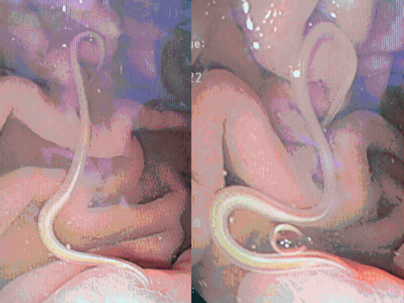 吳文傑醫生表示，病者因進食魚生後感染寄生蟲。（相片獲吳文傑醫生授權轉載） 