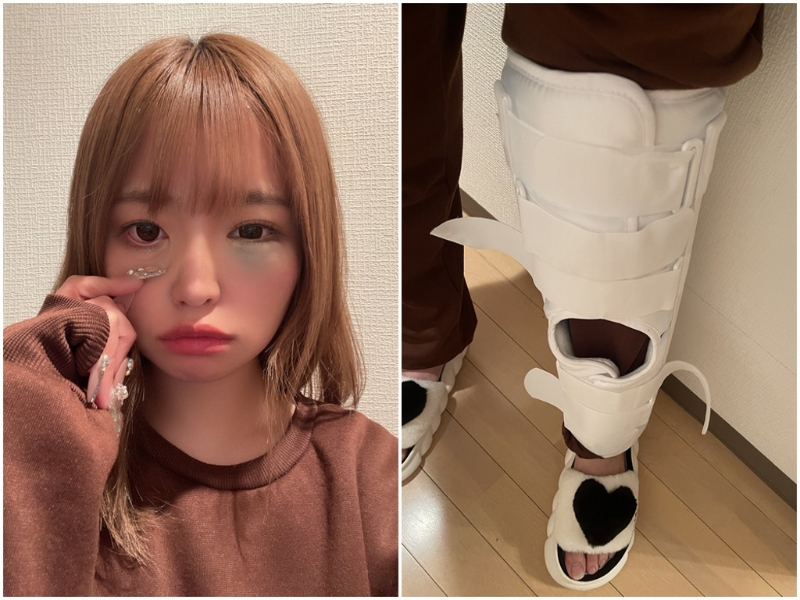 椿莉香傷勢不輕。(圖/twitter@G_Style_rika)