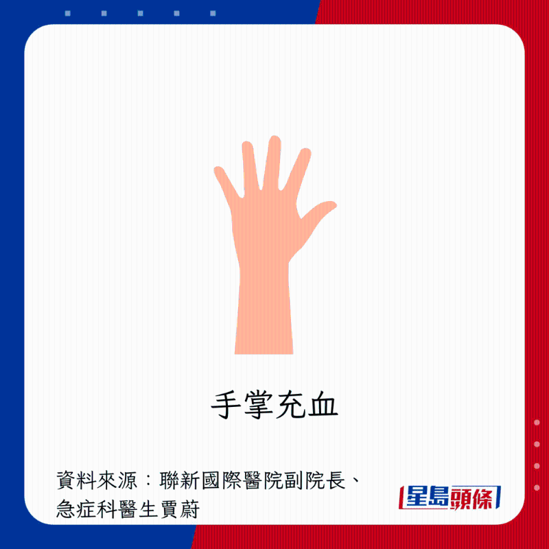  肝臟過勞警號：手掌充血