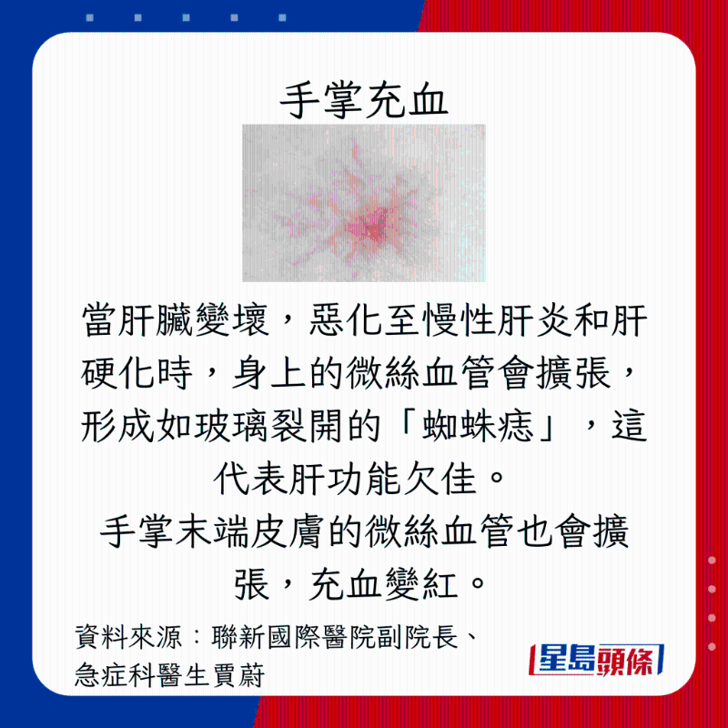 肝臟過勞警號：手掌充血