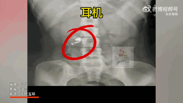 山東男曬出X光影像，其腹部區域確實有一隻耳機橫躺在裡面。