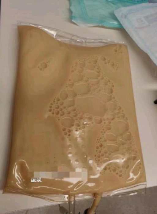 从莫妇体内滤出2公升油浆 从莫妇体内滤出2公升油浆