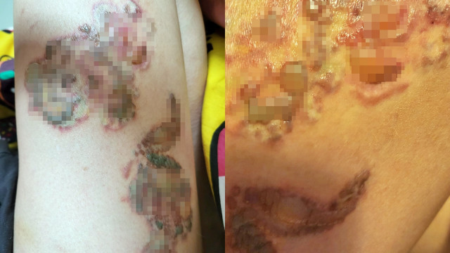 美容院激光洗纹身 美容院激光洗纹身