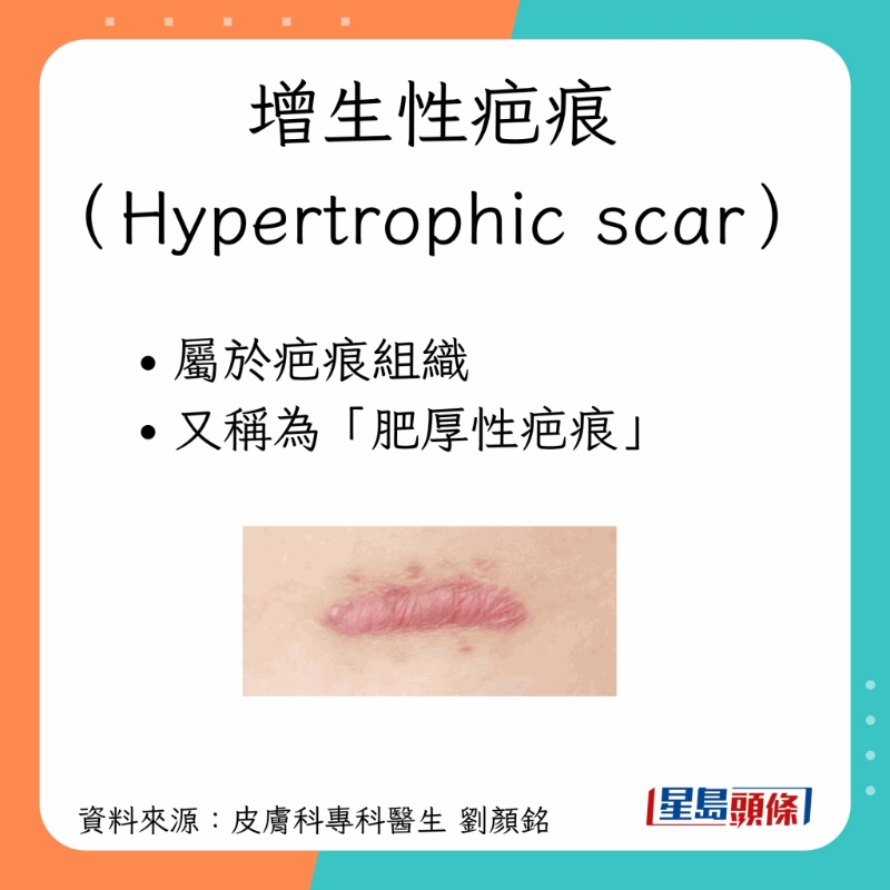 增生性疤痕