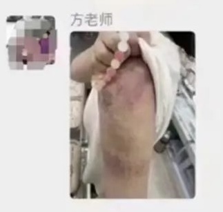 受伤颇为严重 受伤颇为严重