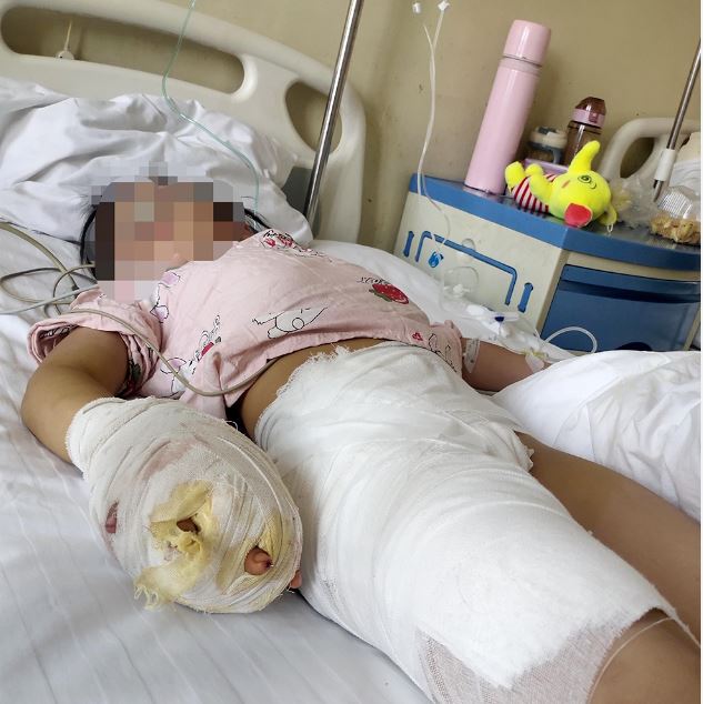 冷血继母虐待7岁妹致残