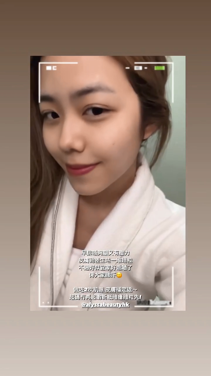 庄子璇前日在IG Story大呼压力大长痘痘。 庄子璇前日在IG Story大呼压力大长痘痘。