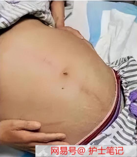 女子便秘10多日致腹部严重胀起 女子便秘10多日致腹部严重胀起