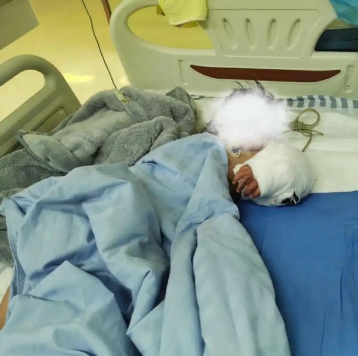 张童的接驳手术效果仍要十天观察 张童的接驳手术效果仍要十天观察