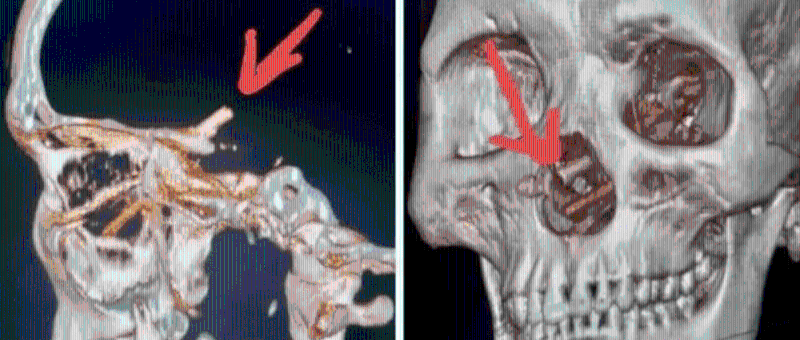 电脑断层扫描显示，男子颅腔内竟一双筷子。