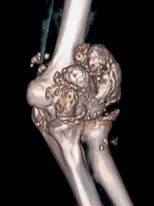 病人的手肘关节内居然长出千余颗“珍珠”状颗粒。
