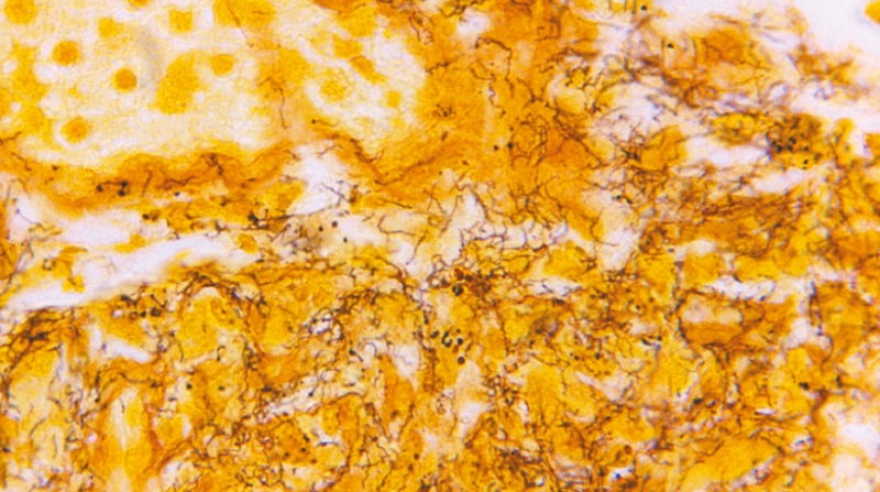 CDC最新数据，曾于国内绝迹的梅毒病例自2018年来急增80%。2022年录得超过20.7万宗，数量比前一年增加17.3%。 美联社