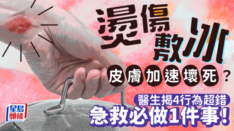 烫伤立即敷冰超错