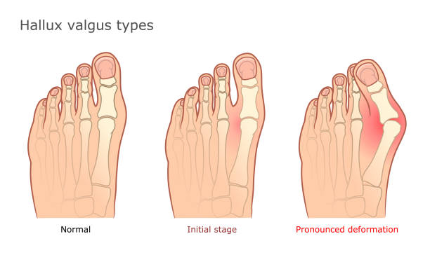 拇趾外翻(Hallux Valgus)为常见足部问题之一(iStock图片) 拇趾外翻(Hallux Valgus)为常见足部问题之一(iStock图片)