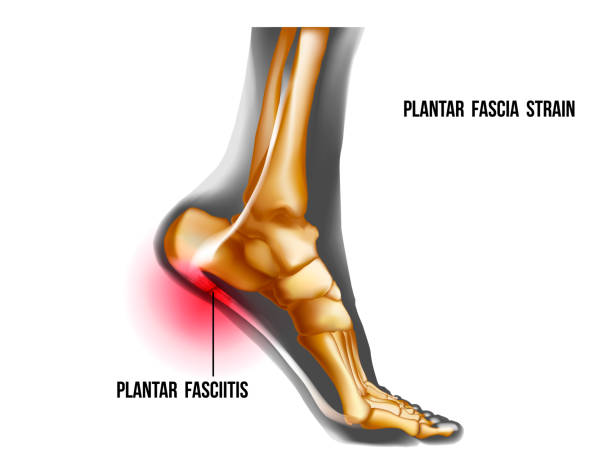 足底筋膜炎(Plantar Fasciitis)为常见足部问题之一(iStock图片) 足底筋膜炎(Plantar Fasciitis)为常见足部问题之一(iStock图片)