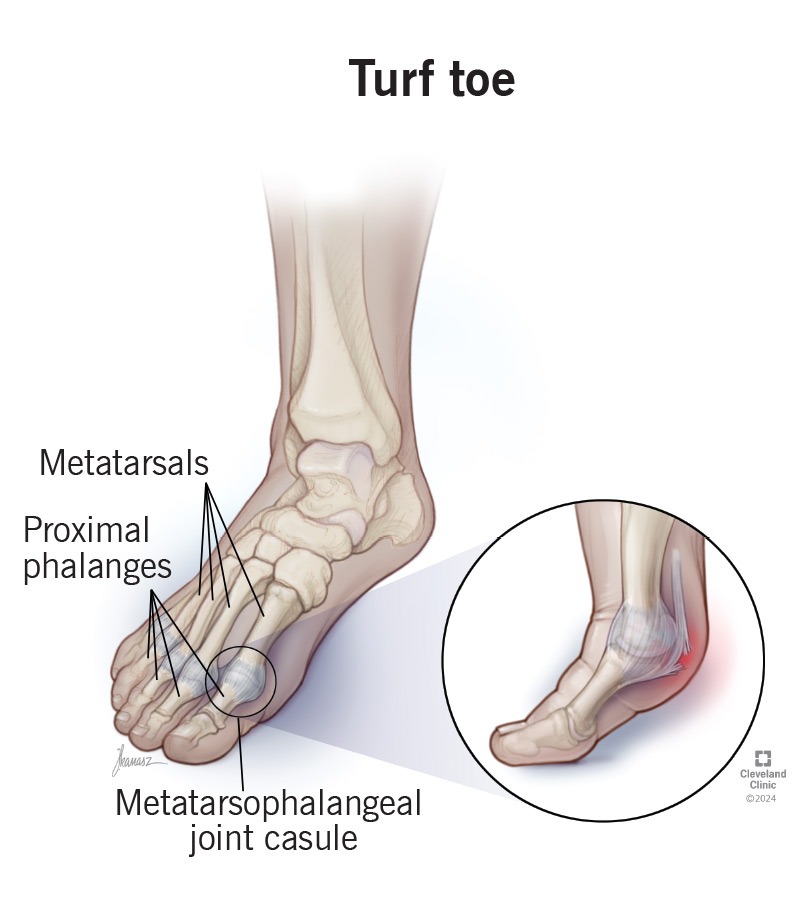 草皮趾(turf toe)为常见足部问题之一(图片来源:Cleveland Clinic) 草皮趾(turf toe)为常见足部问题之一(图片来源:Cleveland Clinic)