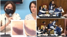 台湾国民党女议员公开腰臂受伤照泪洒记者会 ，“超大片瘀青”