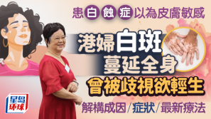 港妇患白癜风以为皮肤敏感,全身白斑,解构成因/症状/治疗方法