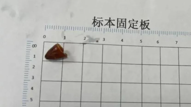 吃火锅导致辣椒入肺,令许先生咳嗽了2年多。 吃火锅导致辣椒入肺,令许先生咳嗽了2年多。