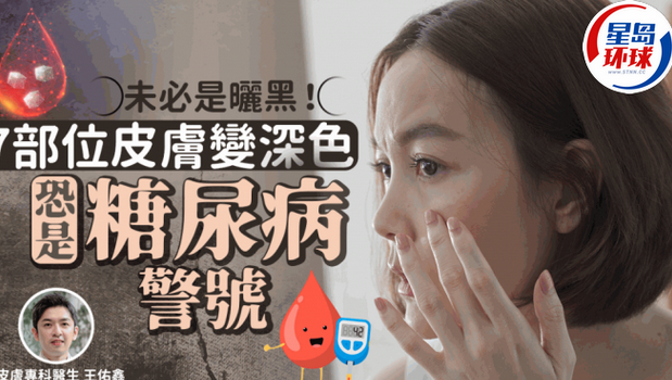 7部位皮肤变深色恐属糖尿病警号 7部位皮肤变深色恐属糖尿病警号