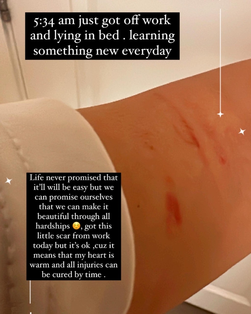 薛凯琪昨日(22日)清晨在IG贴出因工受伤的相片 薛凯琪昨日(22日)清晨在IG贴出因工受伤的相片