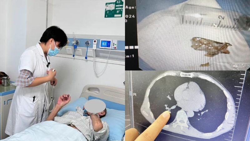 海南男子连日嘴臭咳嗽难受就医，气管发现蟑螂。