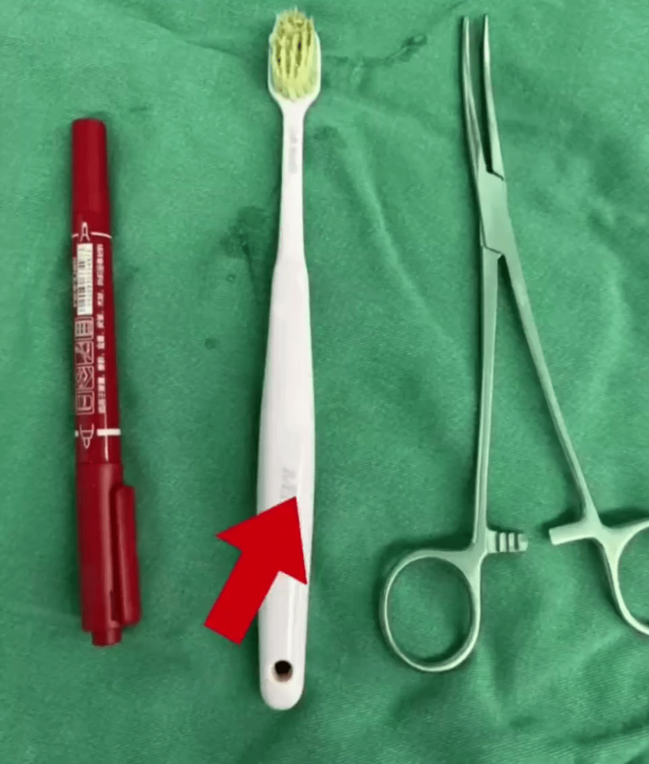 医生从该女子胃中取出的牙刷。 医生从该女子胃中取出的牙刷。