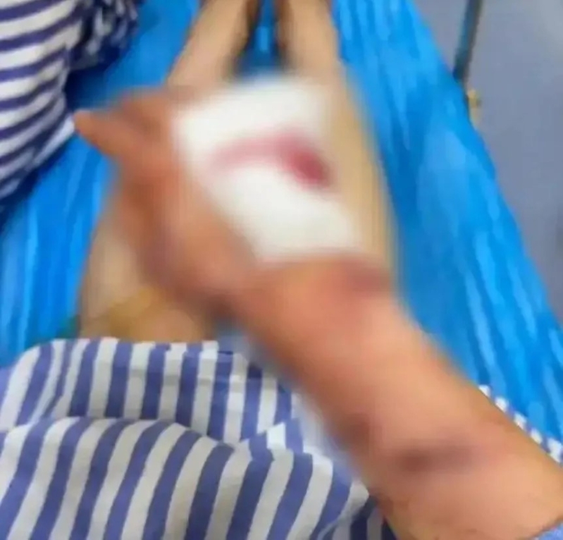 陈小姐右手被玻璃碎片割断手筋。 杭州日报 陈小姐右手被玻璃碎片割断手筋。 杭州日报