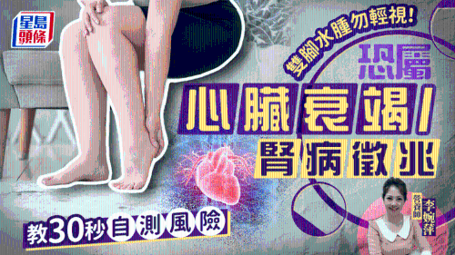 双脚水肿勿轻视！