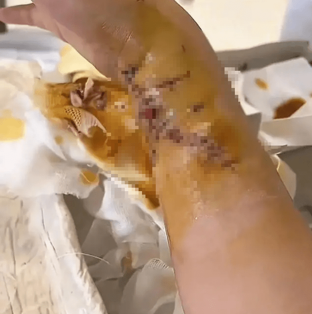 李女士右手被缝了一百多针。 李女士右手被缝了一百多针。