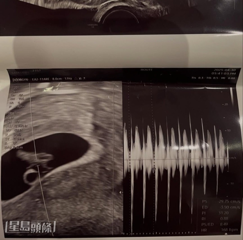 徐敏在于IG大晒胎儿超声波照，宣布怀孕。