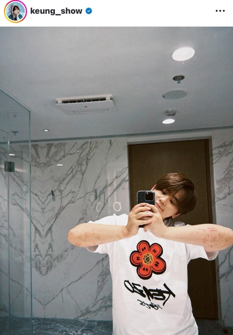 姜涛首次公开两前臂的伤势。1