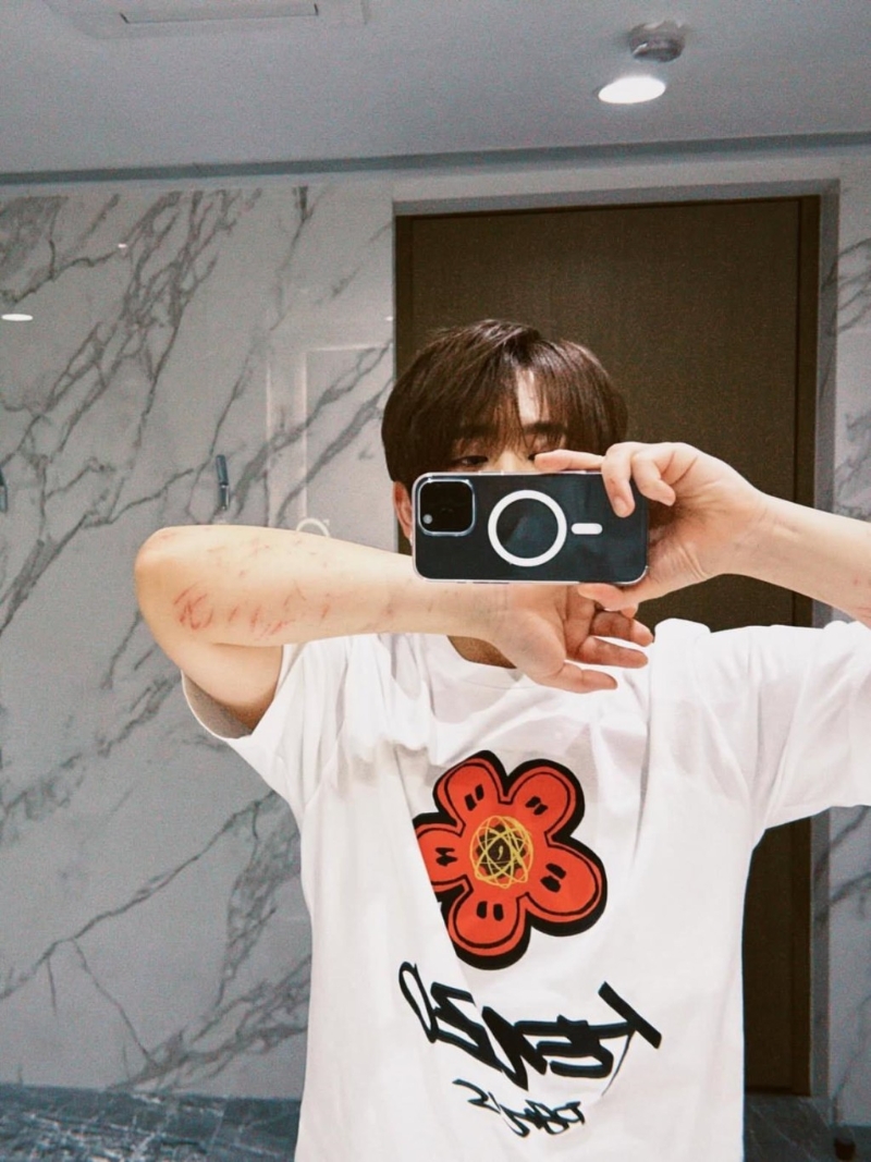 姜涛首次公开两前臂的伤势。