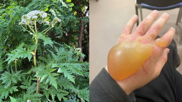 专家在社交平台上发放一张手碰到大豕草汁液后起巨大水泡的照片。