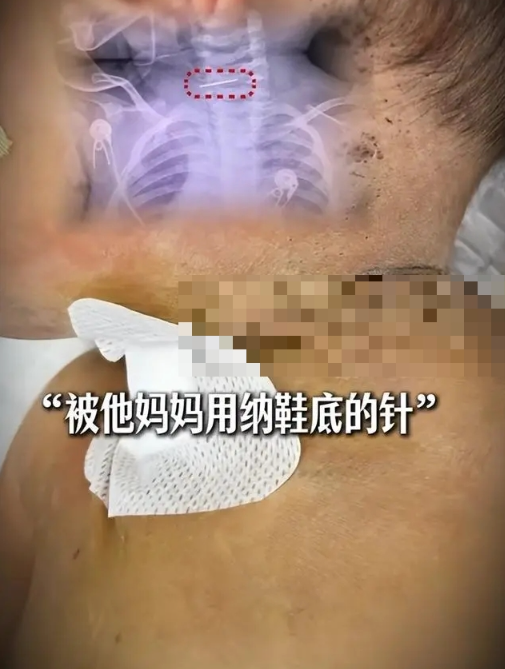 10月大男婴惨遭扎数百针放血 10月大男婴惨遭扎数百针放血