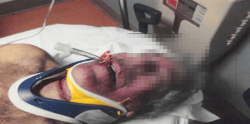 照片显示，爱泼斯坦脸部红肿，脖子上有勒痕