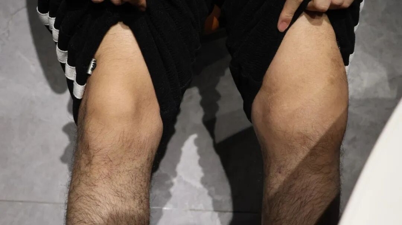 叶胜乐左腿膝盖肿胀，医生判断为出血。