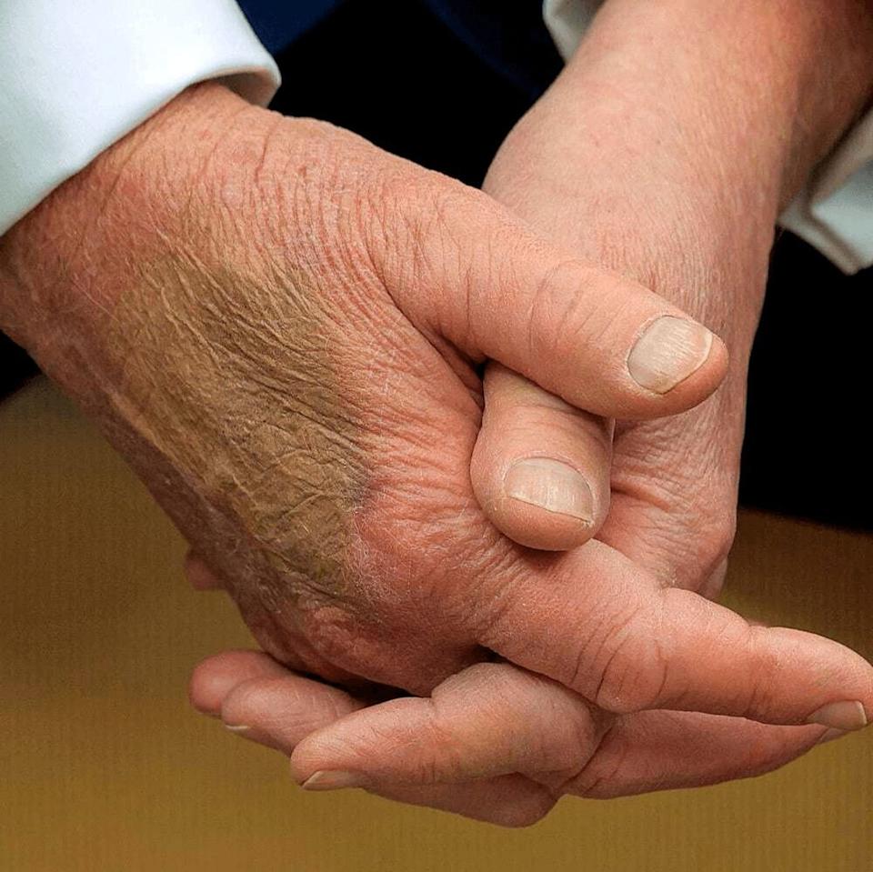 特朗普近年频频被拍到右手背出现大片瘀青，还需用粉底液遮掩。