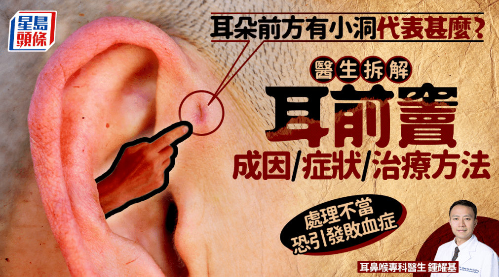 耳朵前方有小洞代表什么 耳朵前方有小洞代表什么